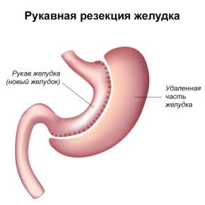 Рукавная гастрэктомия
