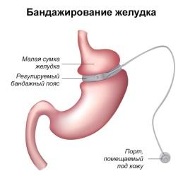 Бандажирование желудка